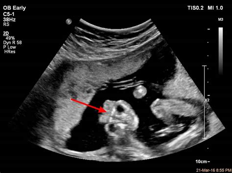 anencephaly dating scan